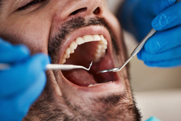 Best Emergency Broken Tooth Repair in Reisterstown, MD